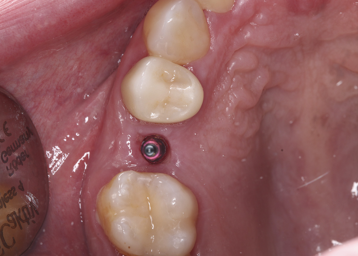 Восстановление зуба коронкой на имплантате