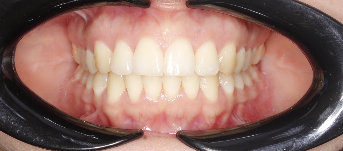 Лечение сужения и скученности зубных рядов