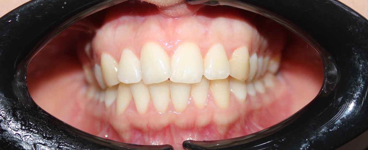 Лечение сужения и скученности зубных рядов