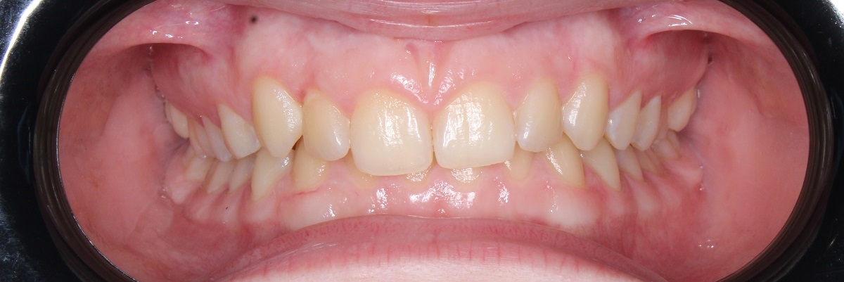 Коррекция глубокого прикуса и канта