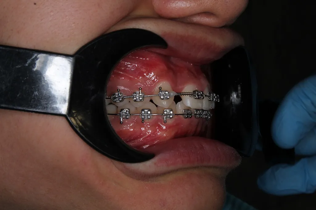 Проблема неправильного прикуса