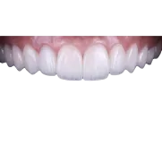 Коронки E-MAX