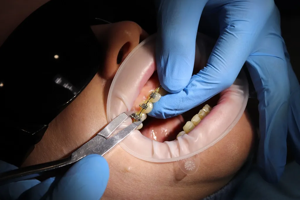 Как подготовиться к установке брекетов