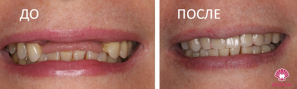 имплантация зубов: до и после