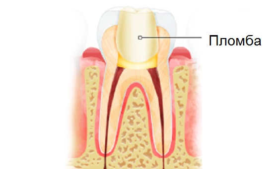 Что представляет собой пломбирование зубов