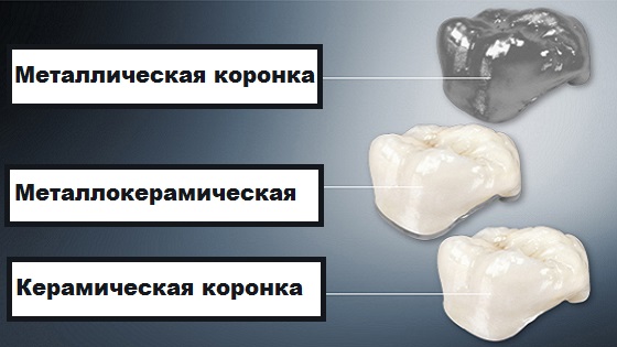 Какие коронки лучше ставить на передние зубы?