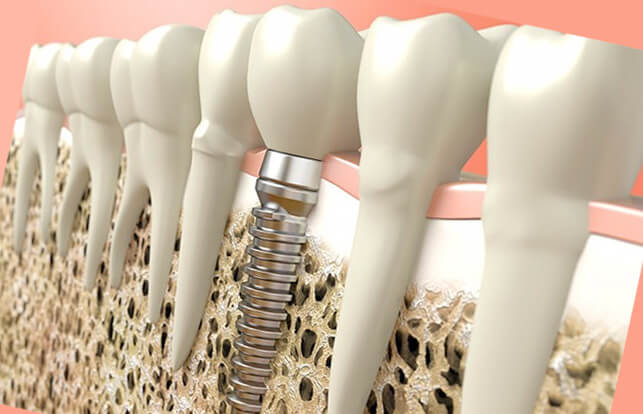 костная ткань зуба при имплантации