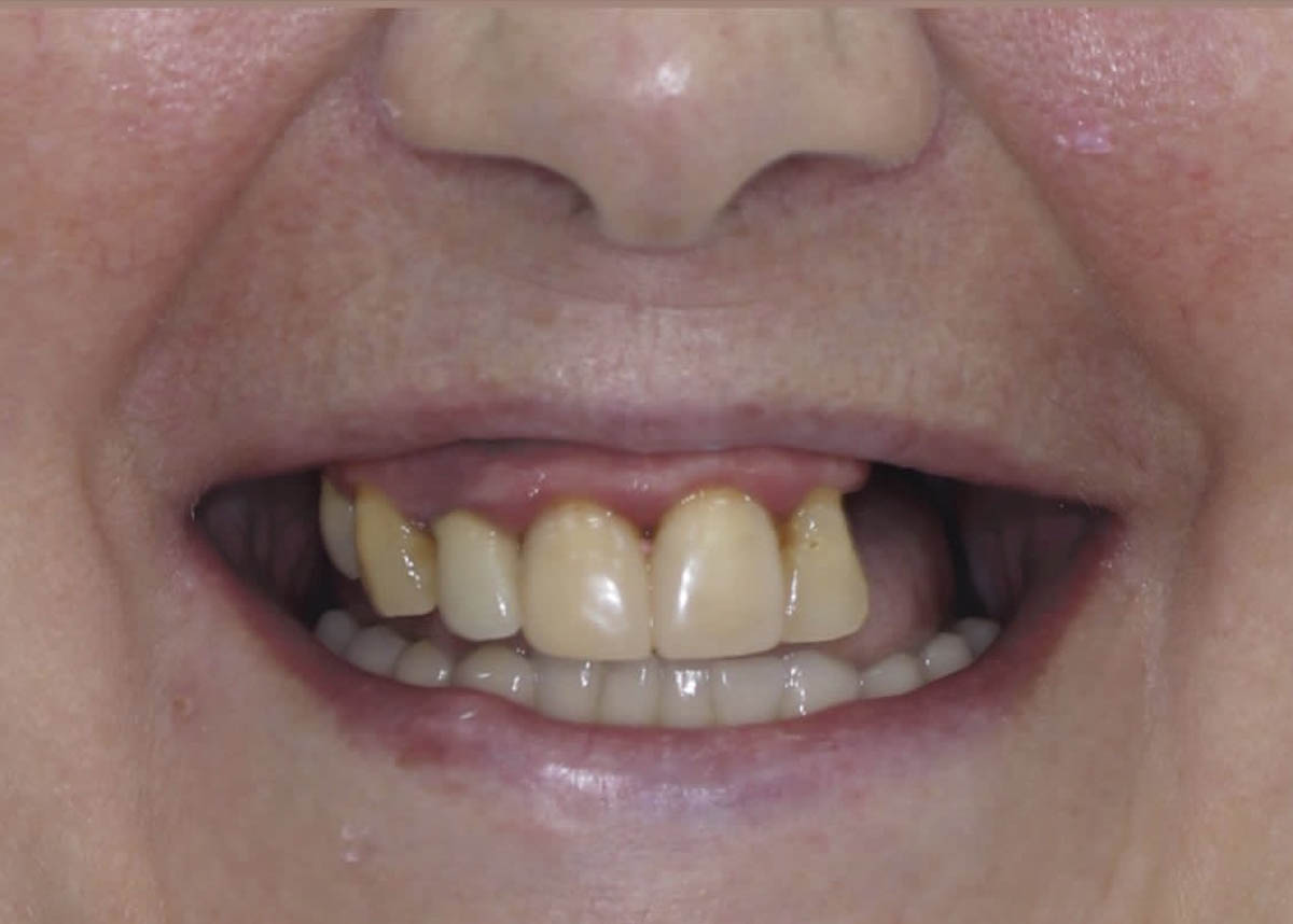 Имплантация зубов верхней челюсти по протоколу All on 4 с последующей установкой керамокомпозитного протеза 