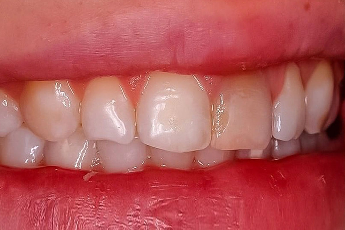 Восстановление функции и эстетики зубов