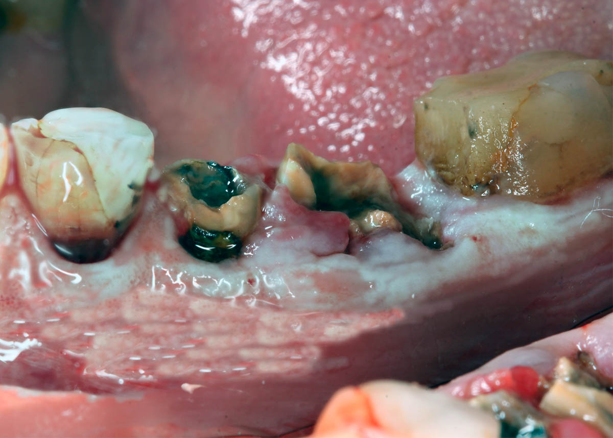 Лечение и восстановление зубов нижнего ряда при помощи имплантации и протезирования