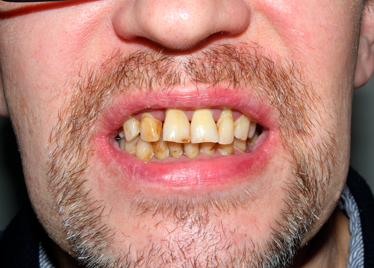 Одномоментная имплантация зубов с немедленной нагрузкой