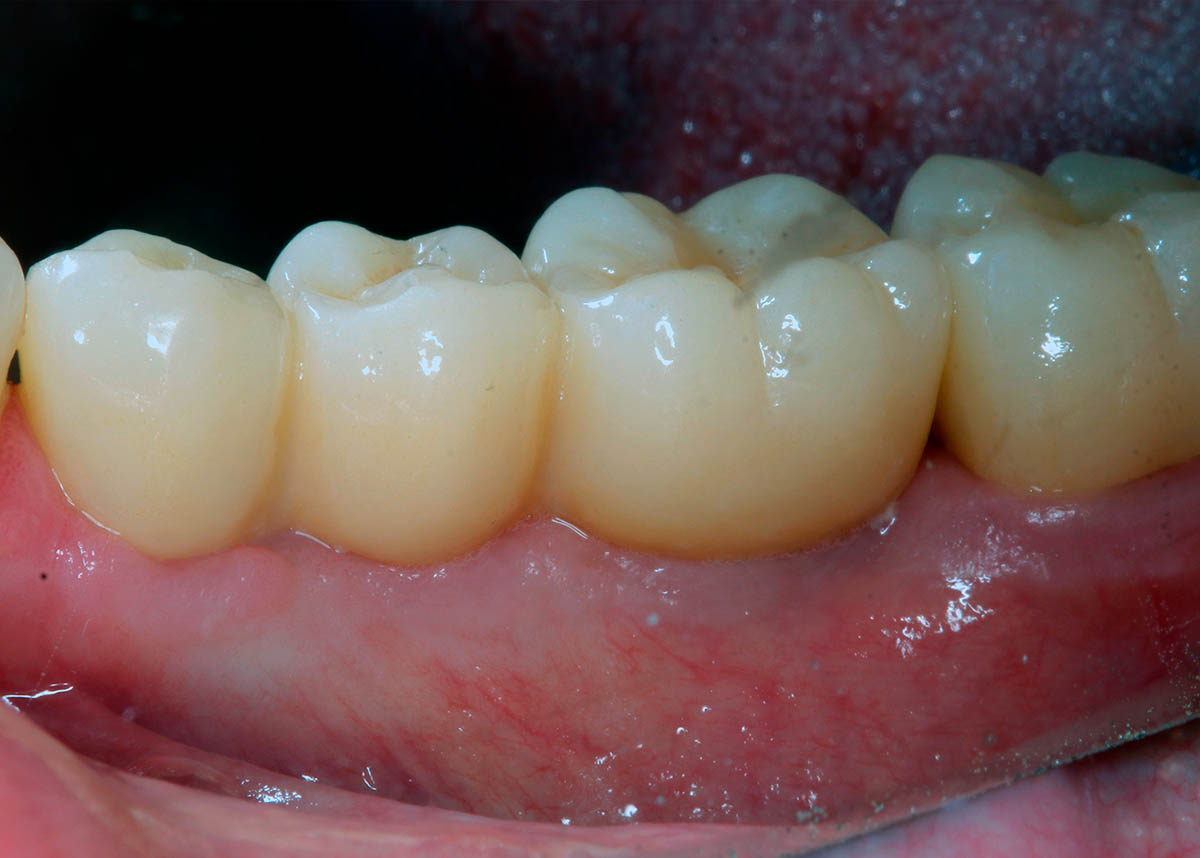 Лечение и восстановление зубов нижнего ряда при помощи имплантации и протезирования