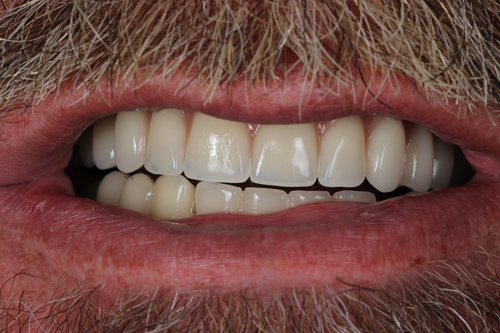Имплантация зубов на верхней челюсти по протоколу 